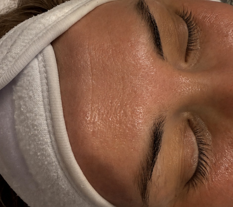 Nachher Microneedling