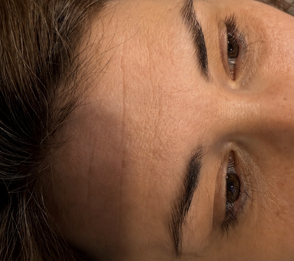 Vorher Microneedling