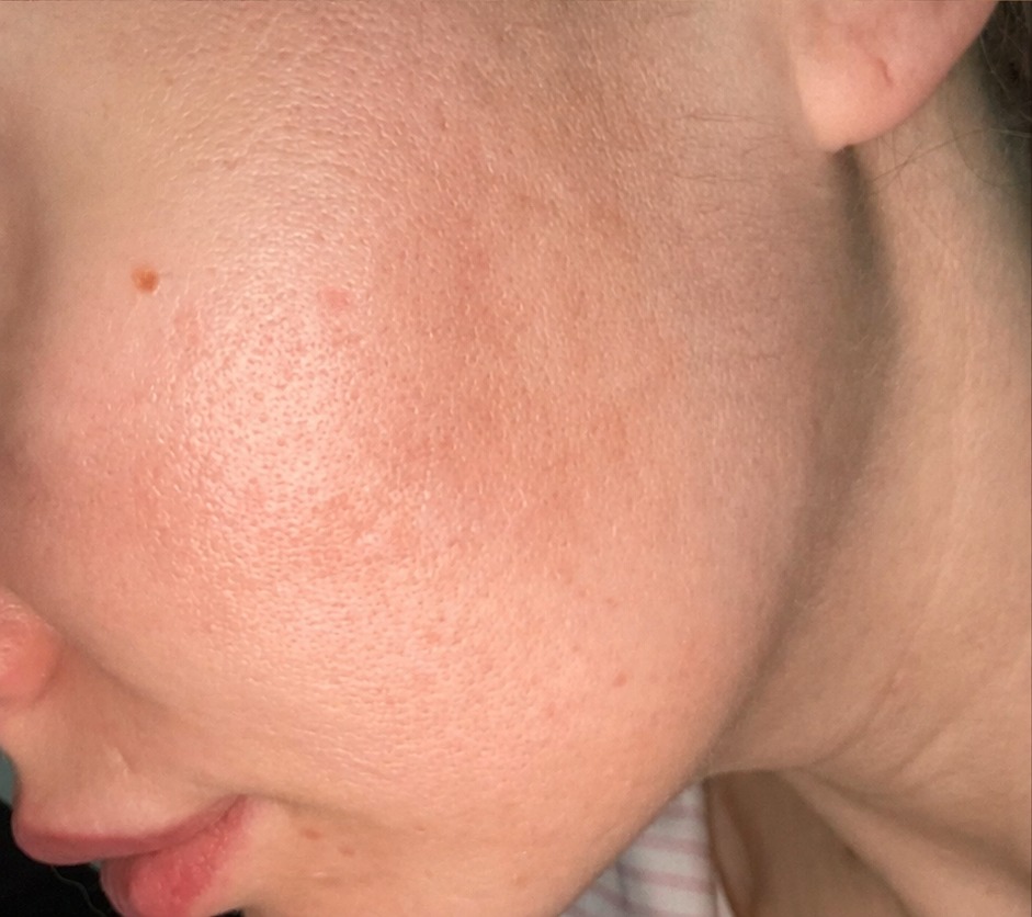 Nachher RF Microneedling