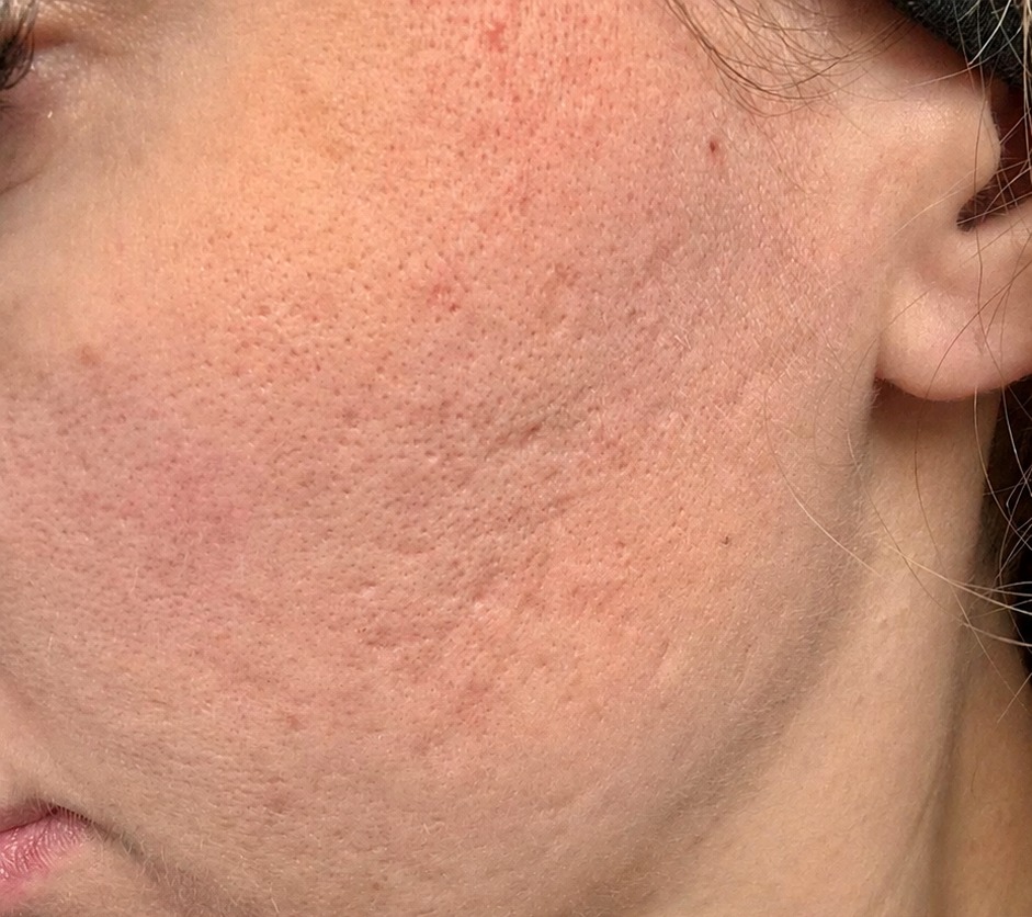Vorher RF Microneedling