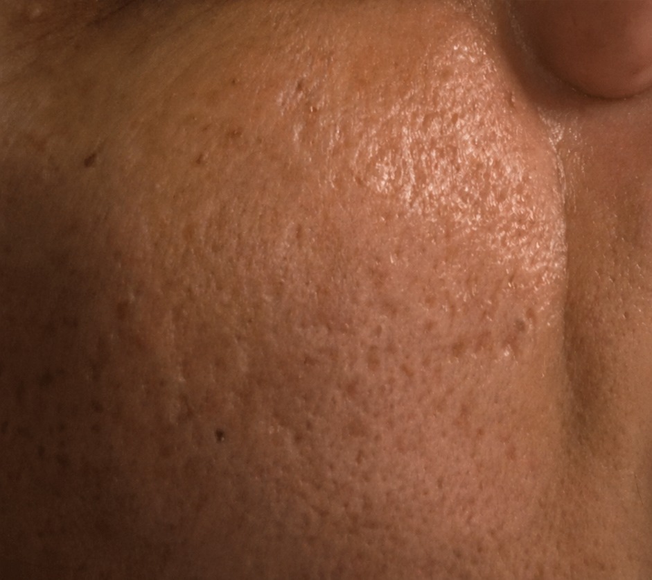 Nachher RF Microneedling