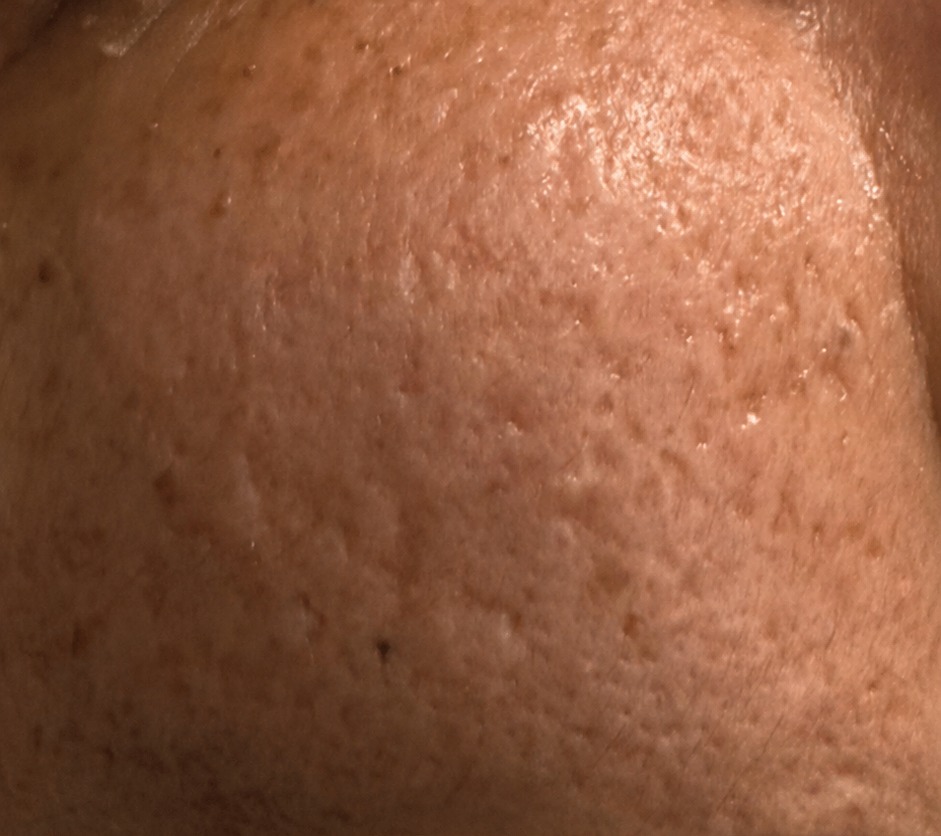 Vorher RF Microneedling