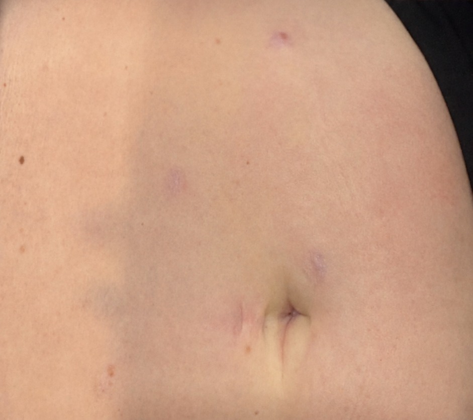Nachher RF Microneedling