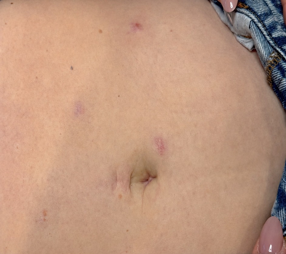 Vorher RF Microneedling