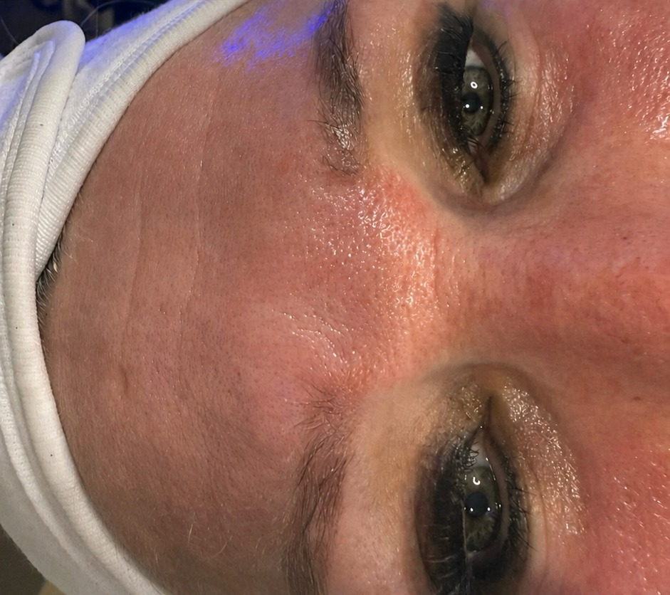 Nachher RF Microneedling