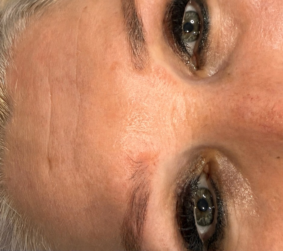 Vorher RF Microneedling